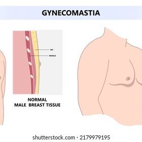 Gynecomastia